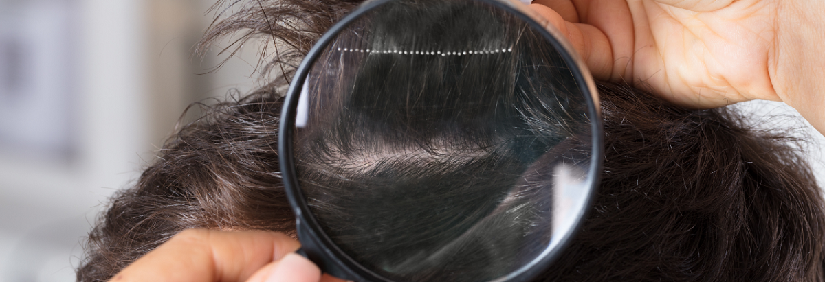 A common problem of hair loss
